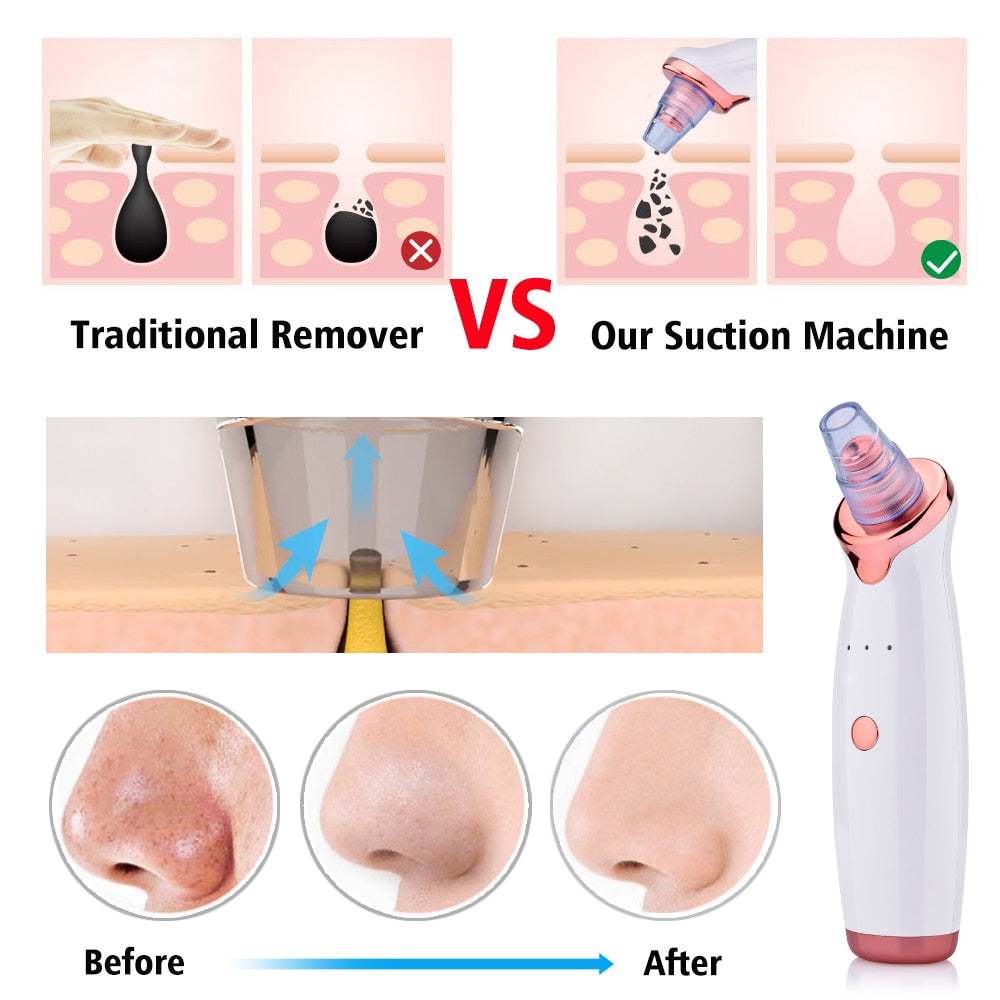 Pore and blackhead cleaner