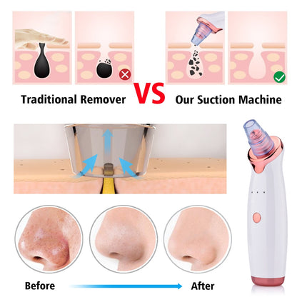 Pore and blackhead cleaner